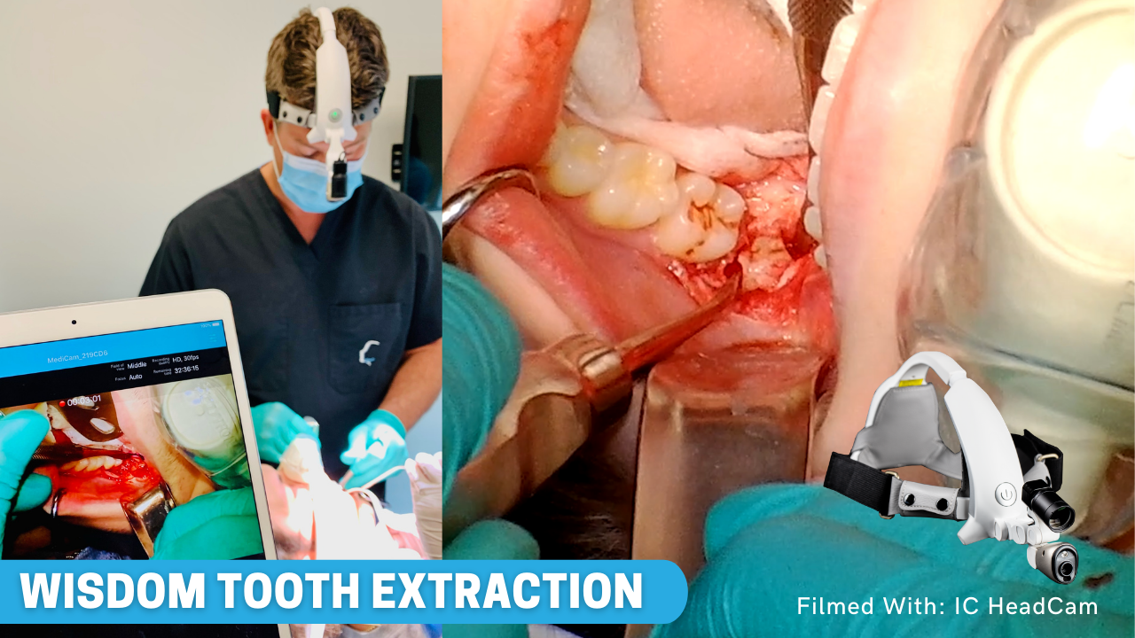 IC HeadCam 10K Lux LED Full-HD Dental Camera